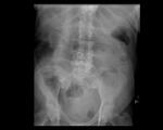 Large bowel obstruction