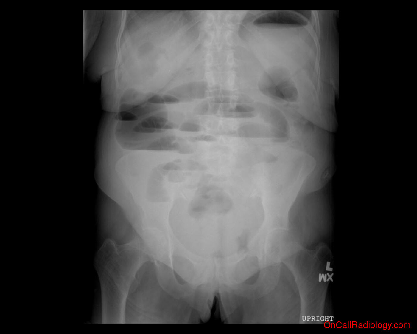Bowel obstruction  (Large bowel obstruction - Plain film, Radiograph)
