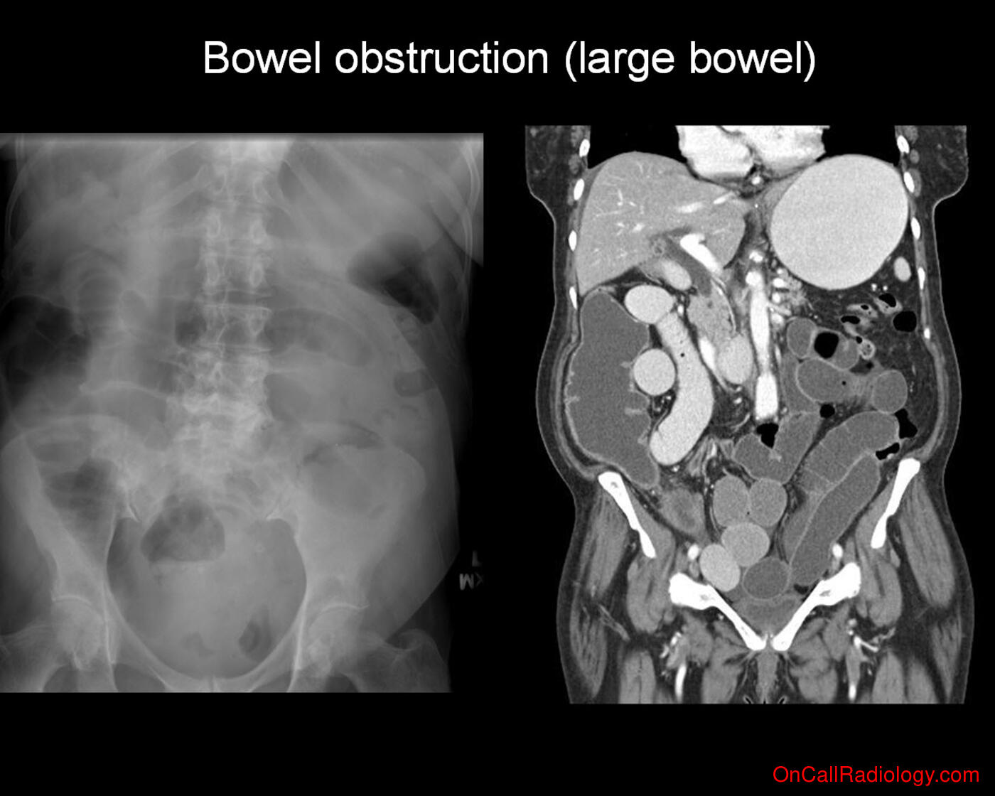 Bowel obstruction  (Large bowel obstruction - Plain film, Radiograph)