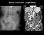 Large bowel obstruction
