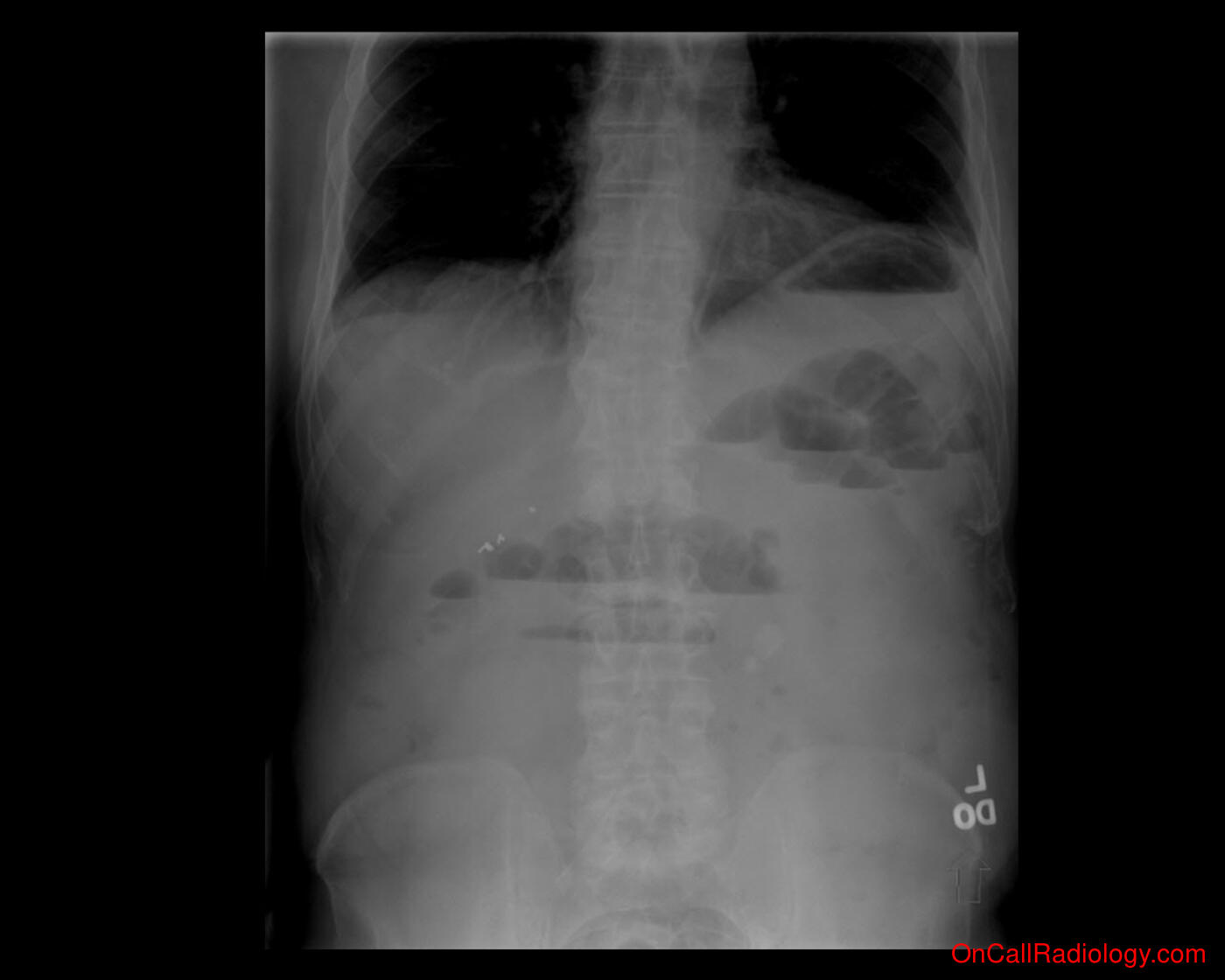 Bowel obstruction  (Signs - Plain film, Radiograph, CT, Computed tomography)