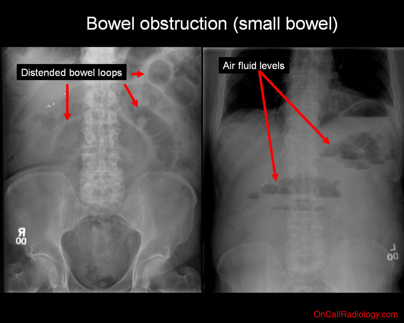 Bowel obstruction  (Signs - Plain film, Radiograph, CT, Computed tomography)