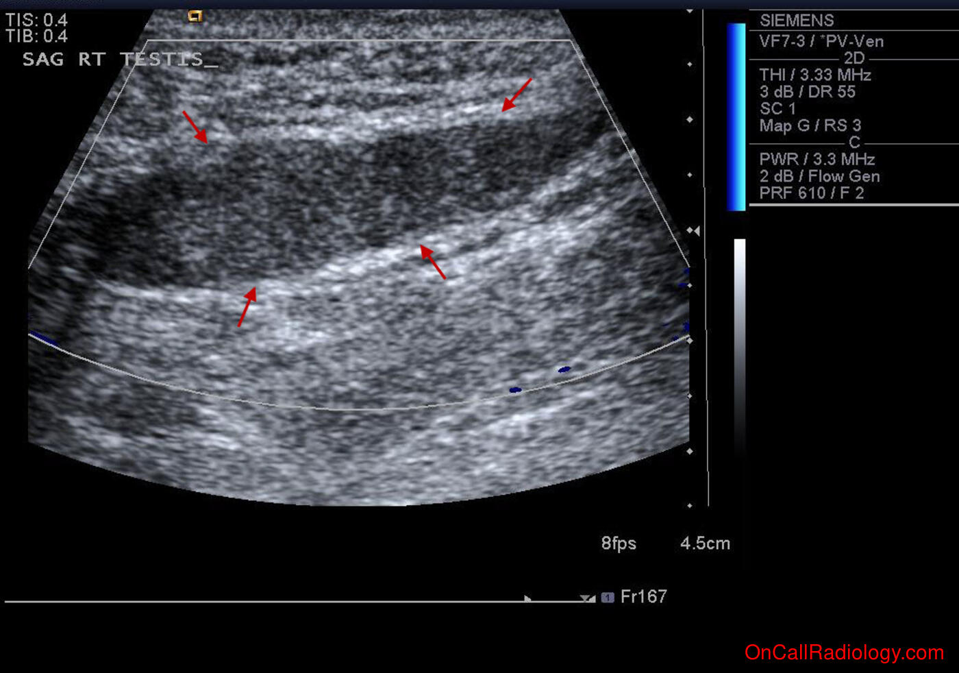 Male (Avascular testis in inguinal canal - Ultrasound)