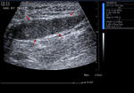 Avascular testis in inguinal canal