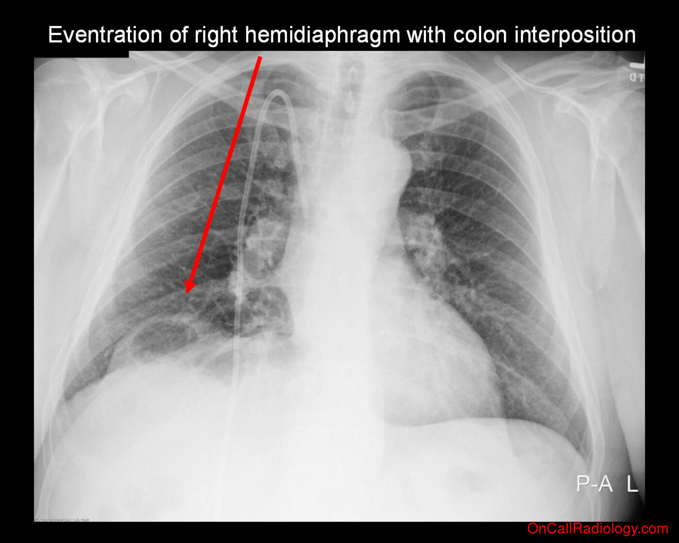 Air where it not belongs (Colonic interposition - Plain film, Radiograph)