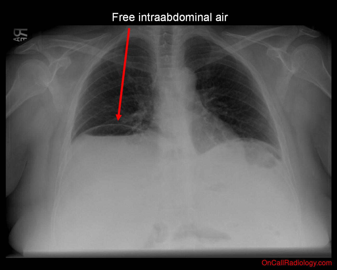 Air where it not belongs (Free intraabdominal air  - Plain film, Radiograph)