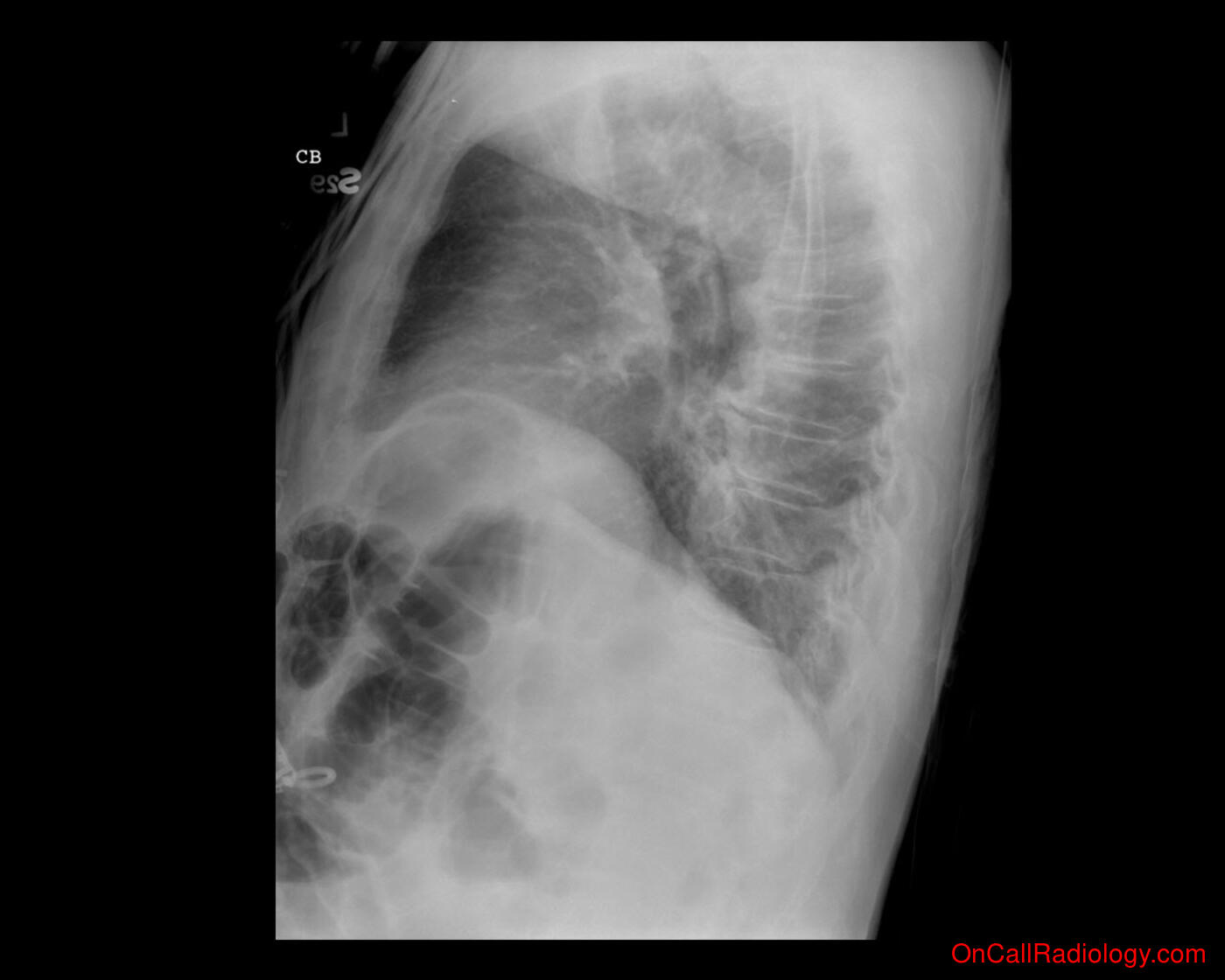 Air where it not belongs (Colonic interposition - Plain film, Radiograph, CT, Computed tomography)