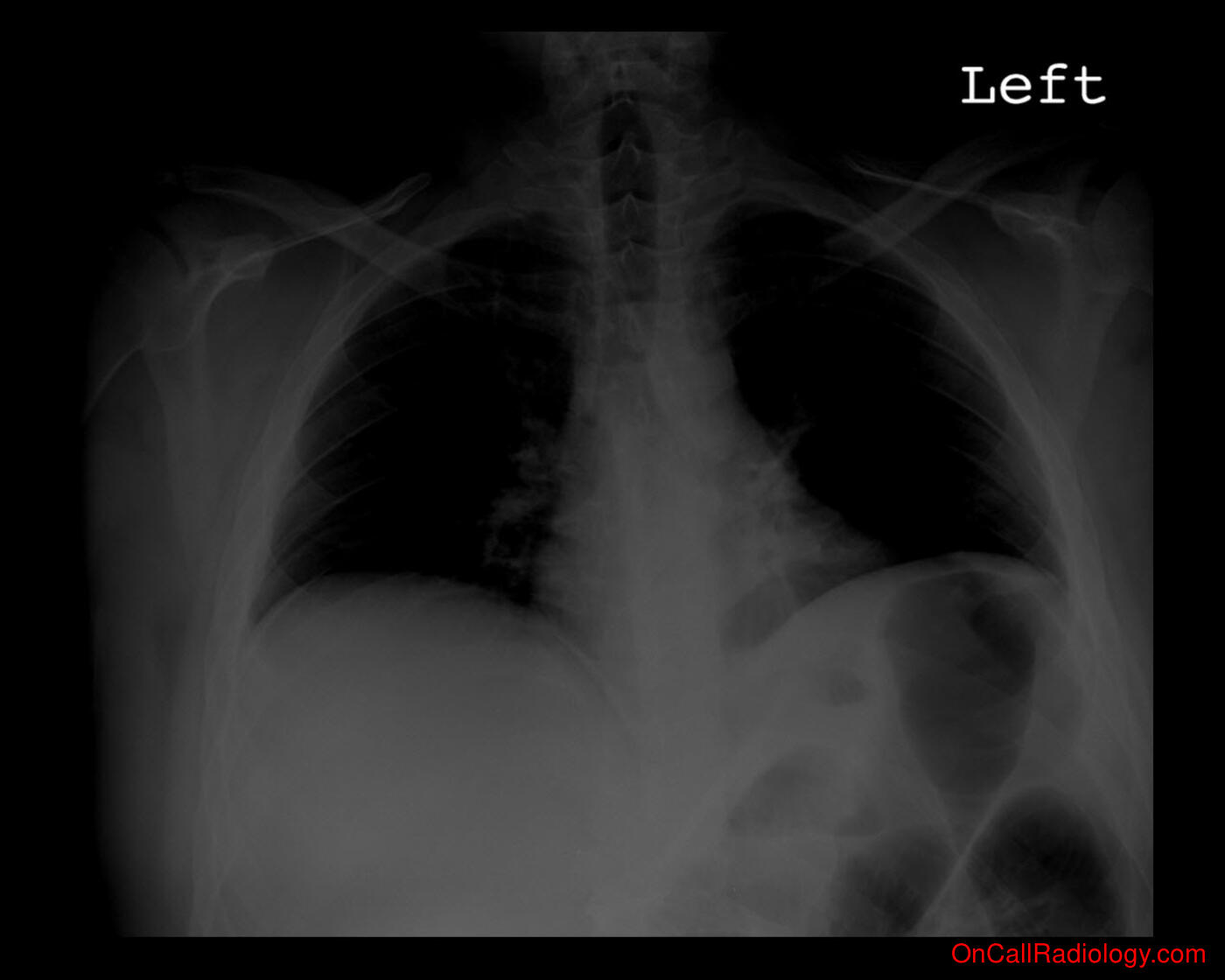 Air where it not belongs (Free intraabdominal air  - Plain film, Radiograph, CT, Computed tomography)