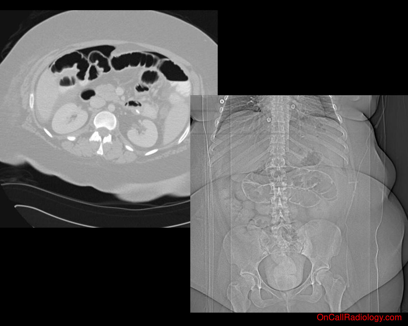 Air where it not belongs (SBO with free intraabdominal air  - Plain film, Radiograph, CT, Computed tomography)