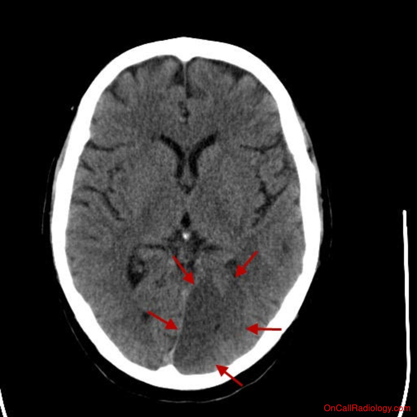Head (Left PCA infarct - CT)