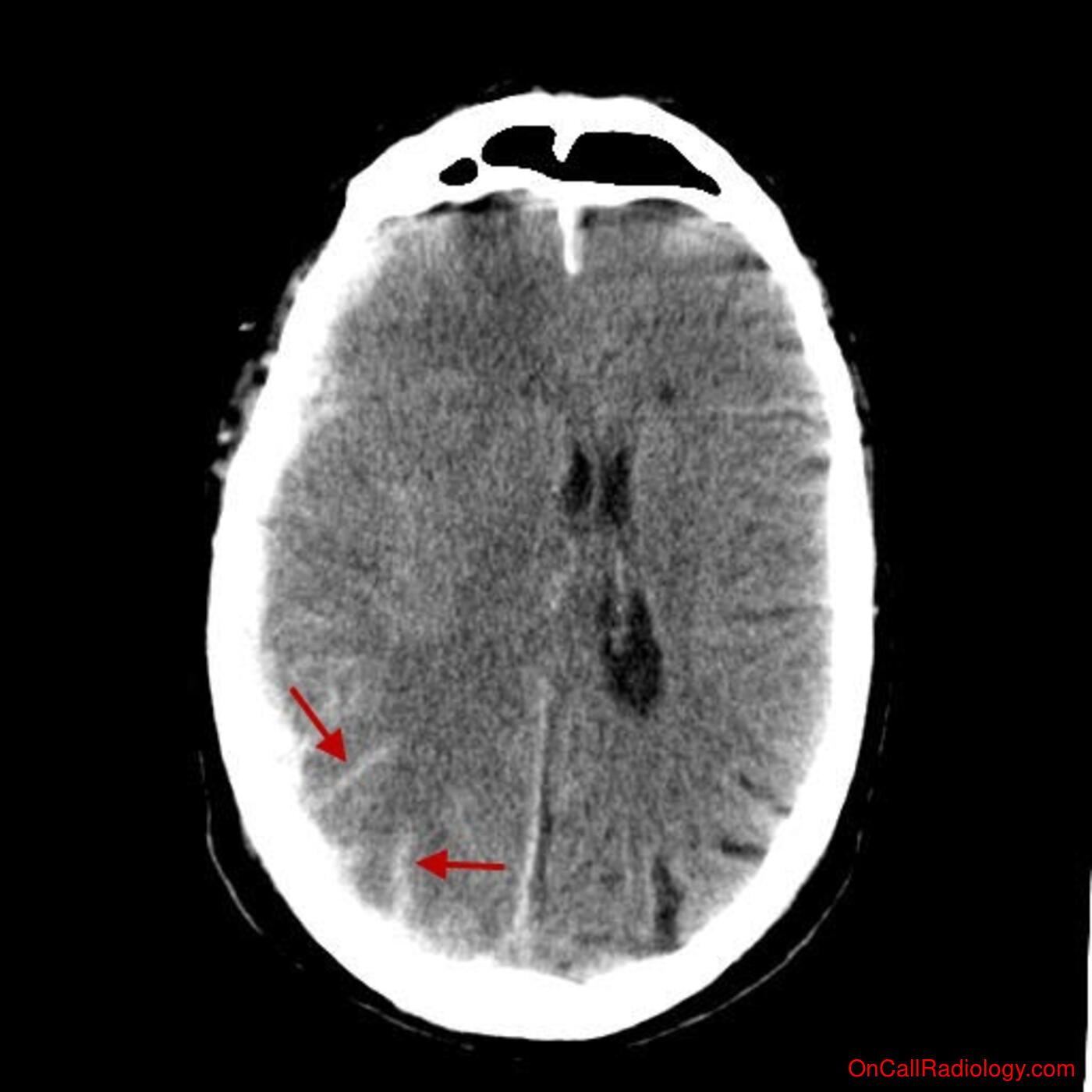 Head (Subarachnoid hemorrhage, subdural bleed, brain edema, cerebral vasospasm - CT, CTA)