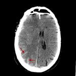 Subarachnoid hemorrhage, subdural bleed, brain edema, cerebral vasospasm