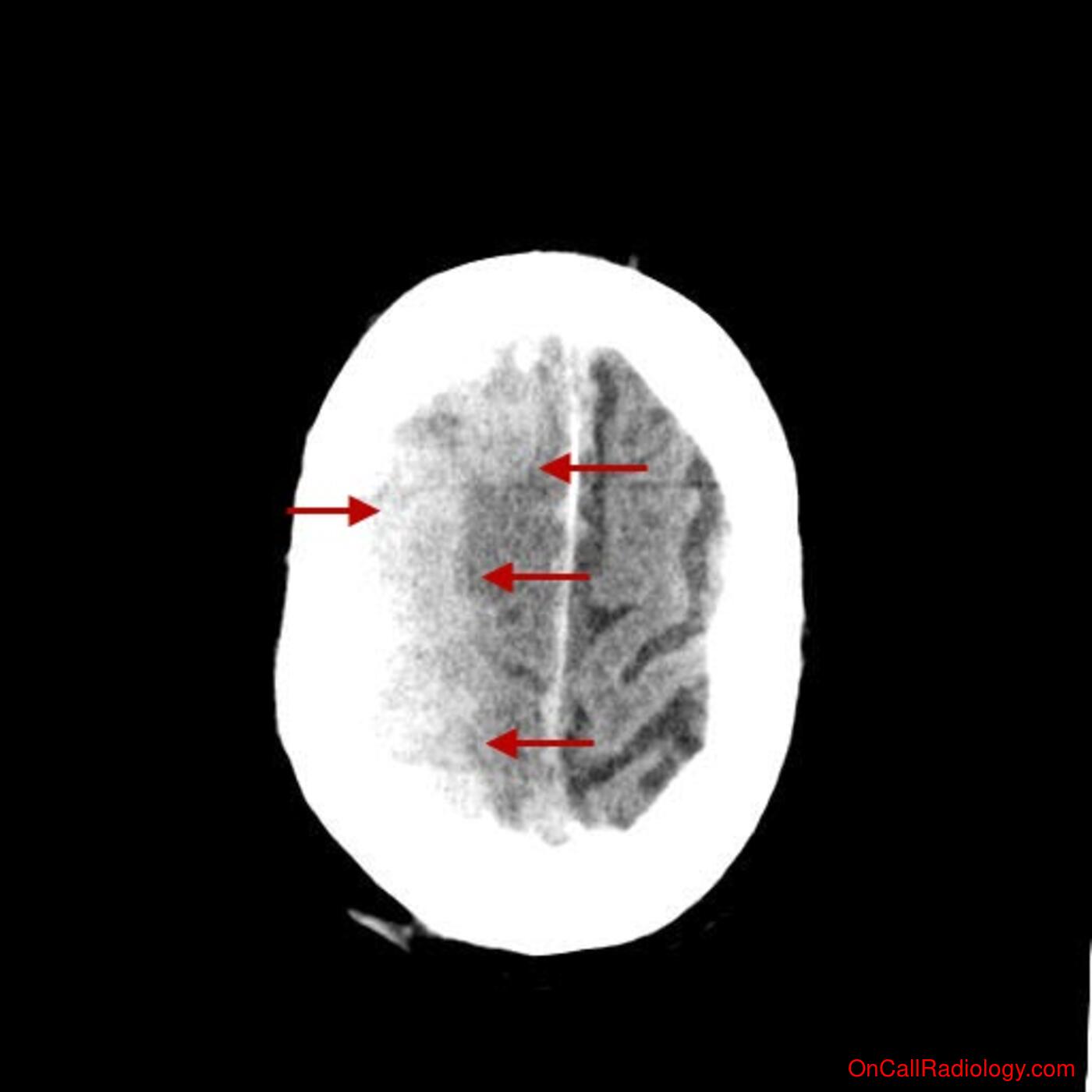 Head (Subarachnoid hemorrhage, subdural bleed, brain edema, cerebral vasospasm - CT, CTA)