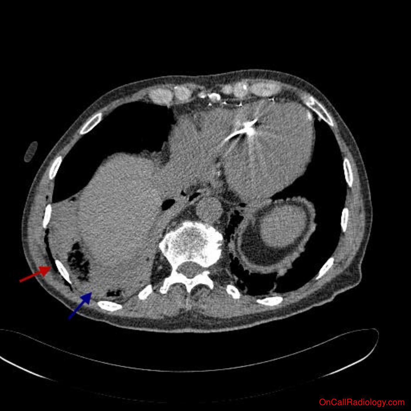 Trauma (Serial rib fractures with hemopneumothorax, incidental lung adenocarcinoma - CT)
