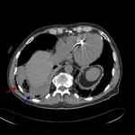 Serial rib fractures with hemopneumothorax, incidental lung adenocarcinoma