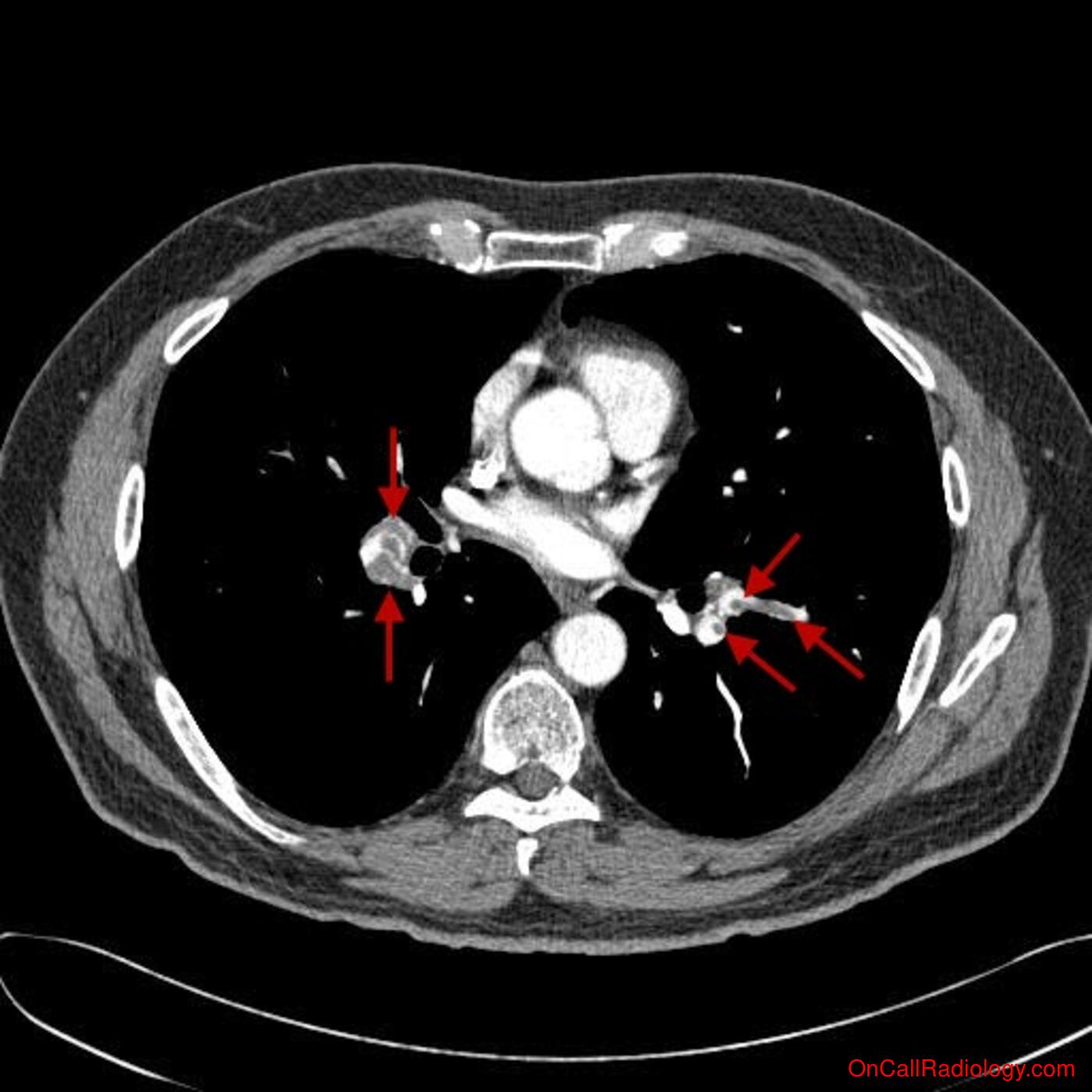 Thromboembolic disease (Shower of pulmonary emboli - CT)