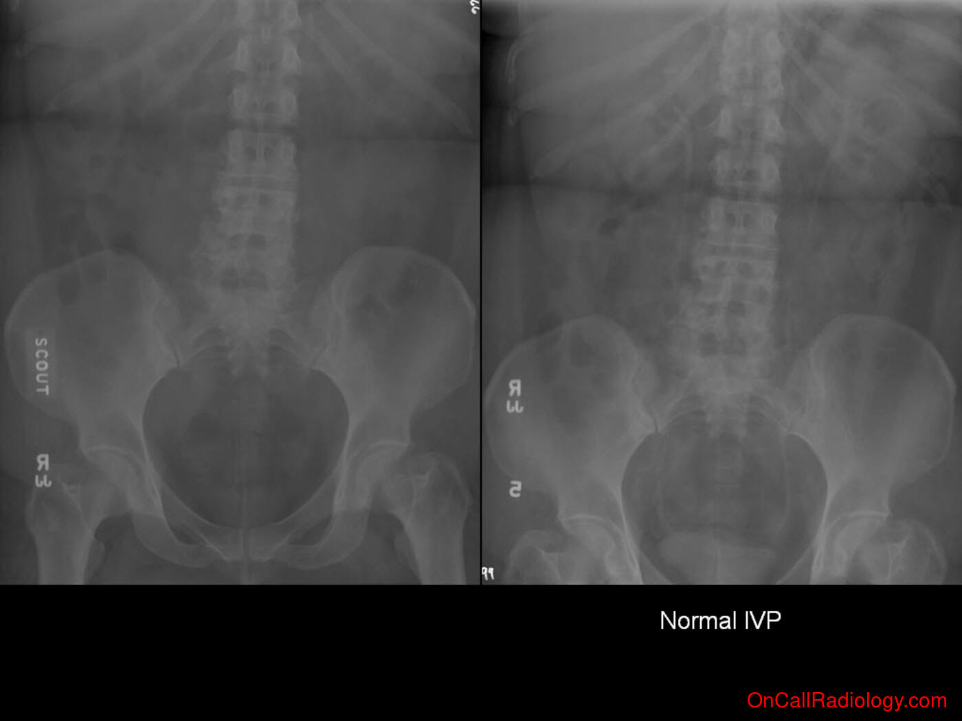 Technique (Normal KUB and IVP - Plain film, Radiograph, IVP)