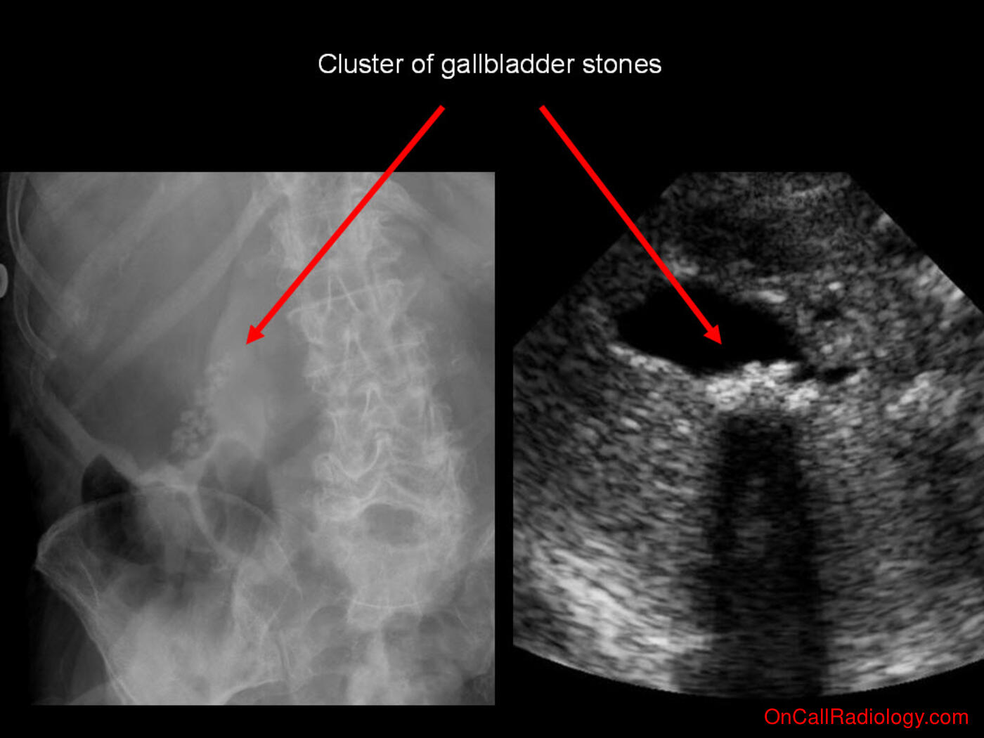 Calcifications (Cholelithiasis - Plain film, Radiograph, Ultrasound)