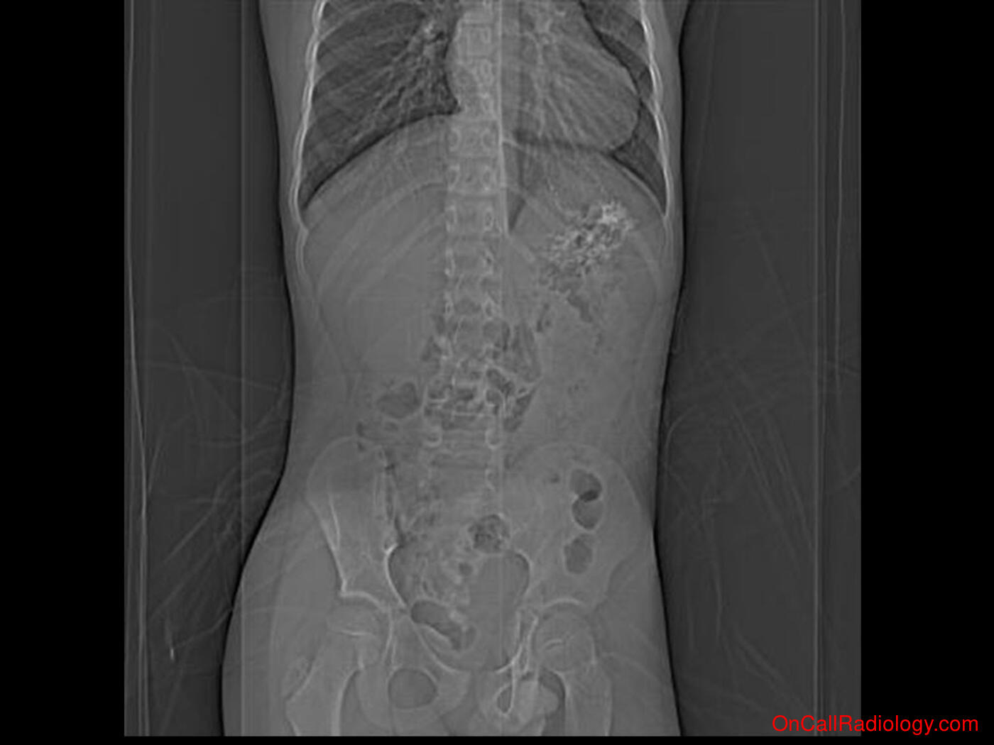 Calcifications (Appendicolith causing acute appendicitis - Plain film, Radiograph, CT, Computed tomography)