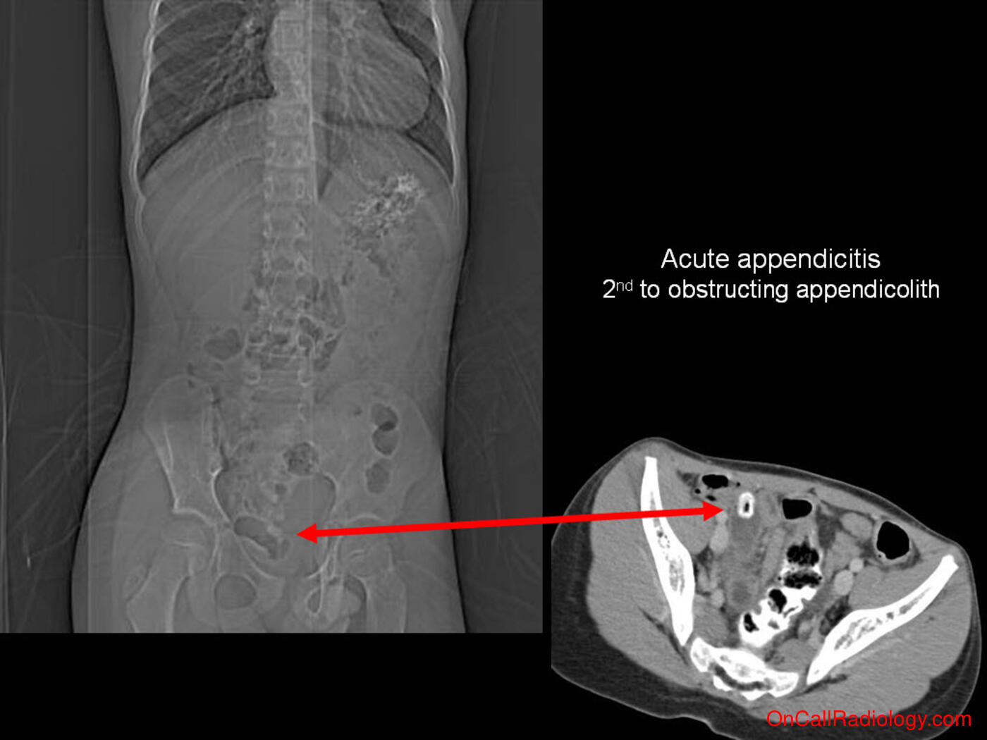 Calcifications (Appendicolith causing acute appendicitis - Plain film, Radiograph, CT, Computed tomography)