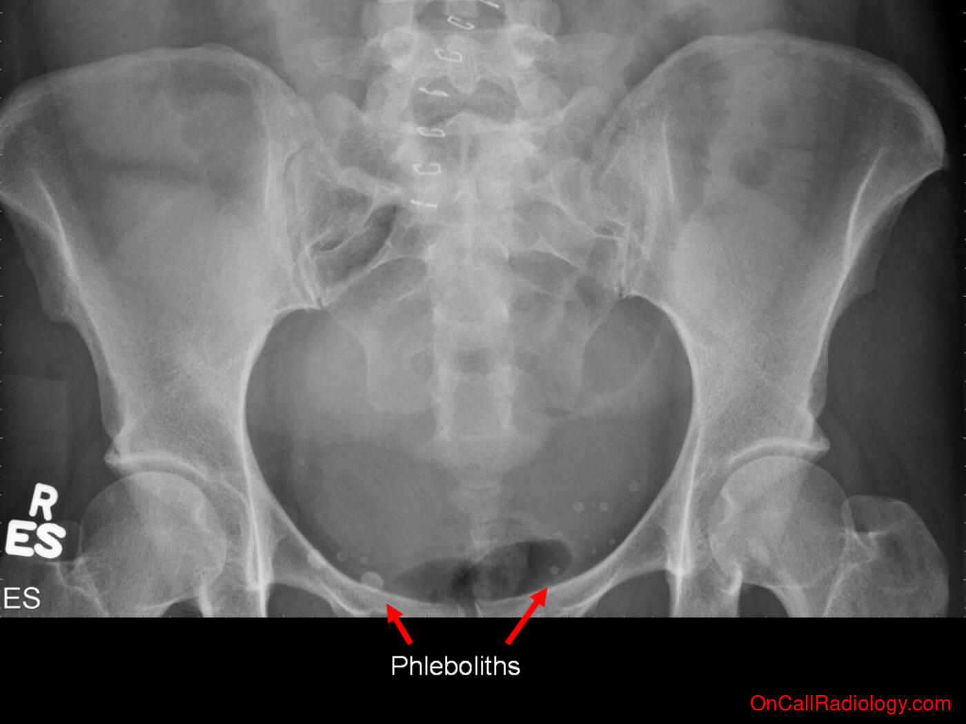 Calcifications (Pelvic phleboliths - Plain film, Radiograph)