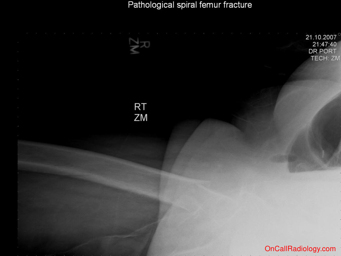 Bones (Pathological spiral femur fracture - Plain film, Radiograph)