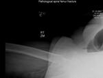 Pathological spiral femur fracture