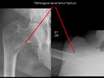 Pathological spiral femur fracture