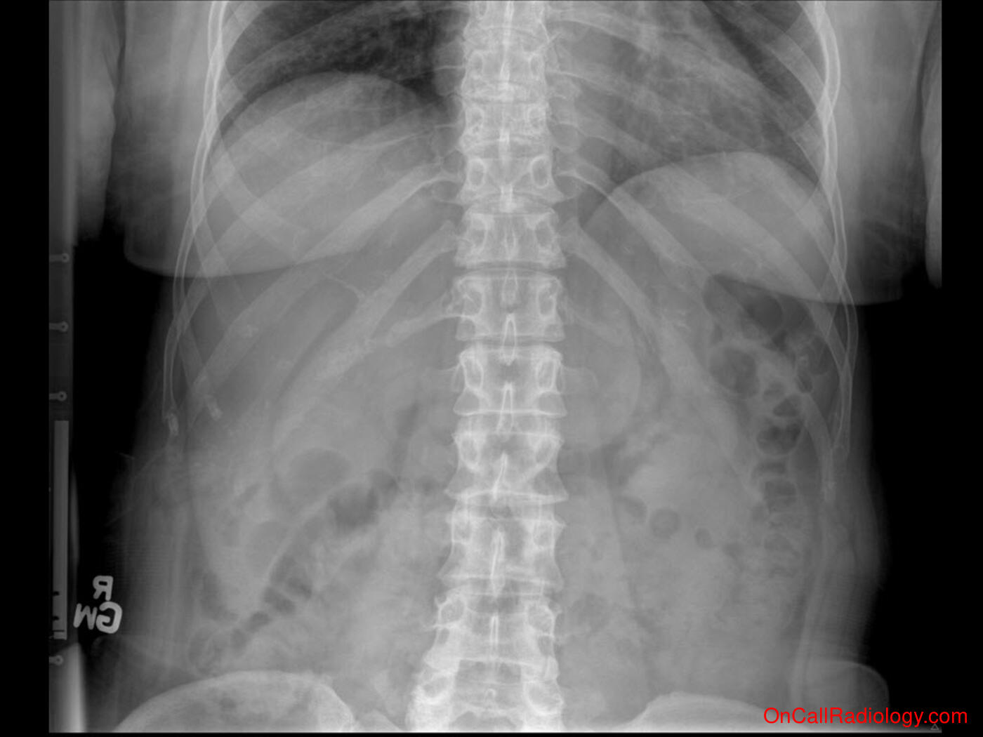 Bones (Rib fracture  - Plain film, Radiograph)