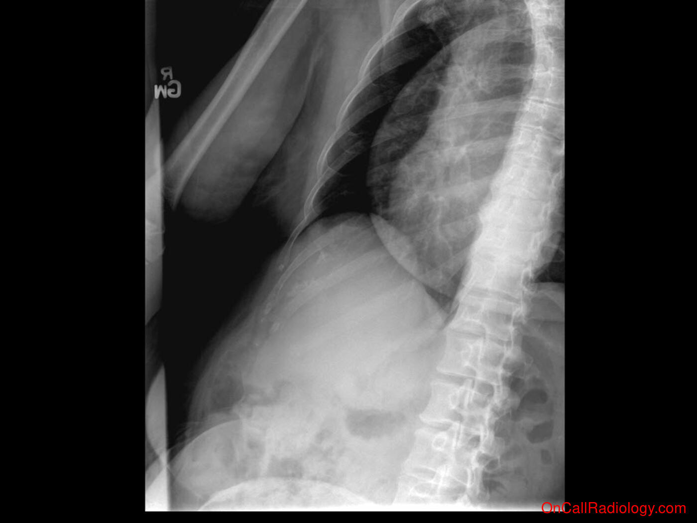 Bones (Rib fracture  - Plain film, Radiograph)