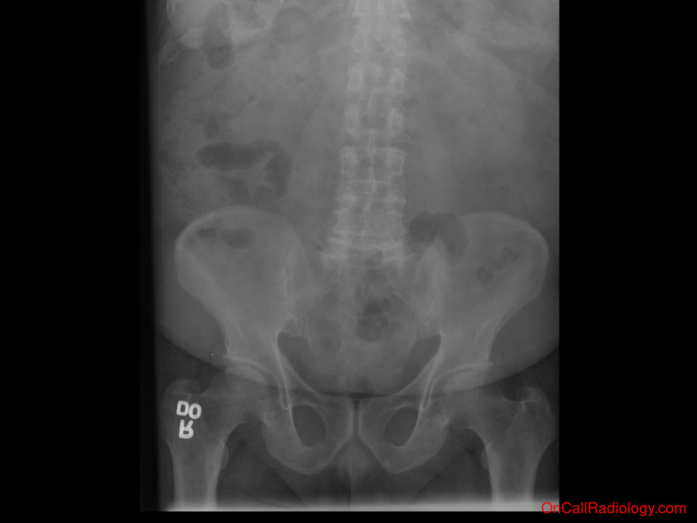 Bones (Vertebral compression fracture - Plain film, Radiograph)