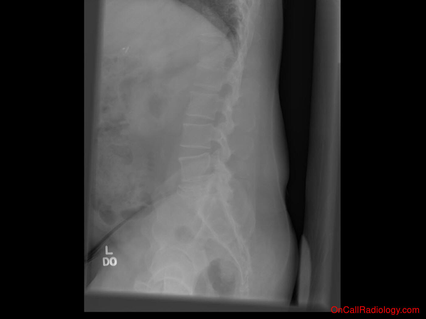 Bones (Vertebral compression fracture - Plain film, Radiograph)