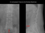 Vertebral compression fracture
