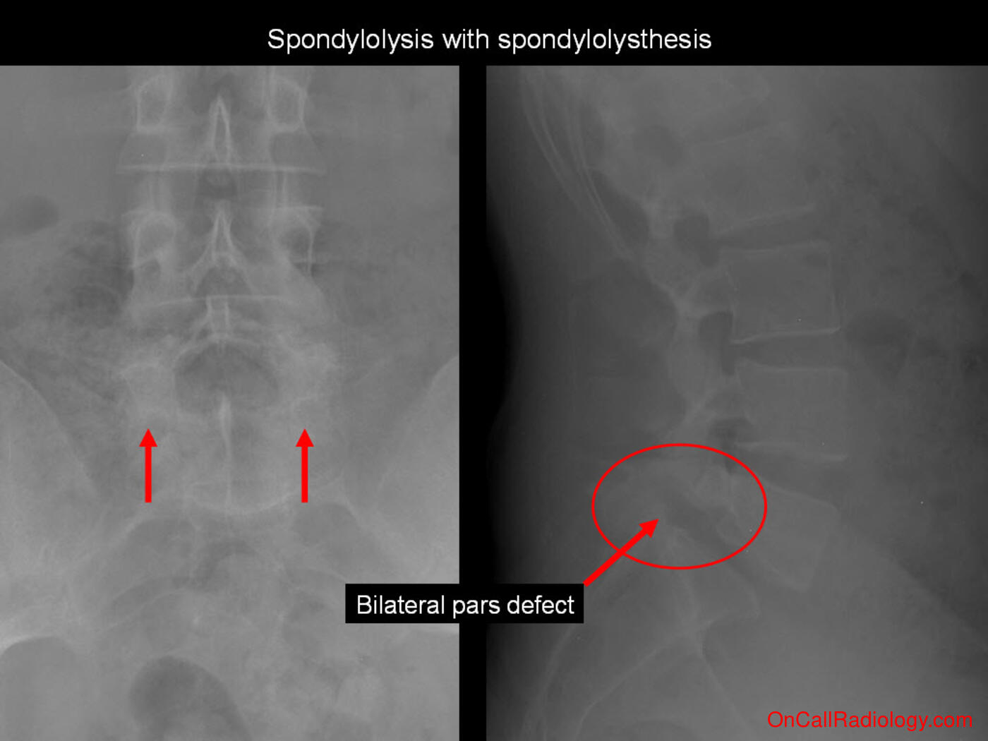 Bones (Spondylolysis with spondylolysthesis - Plain film, Radiograph)