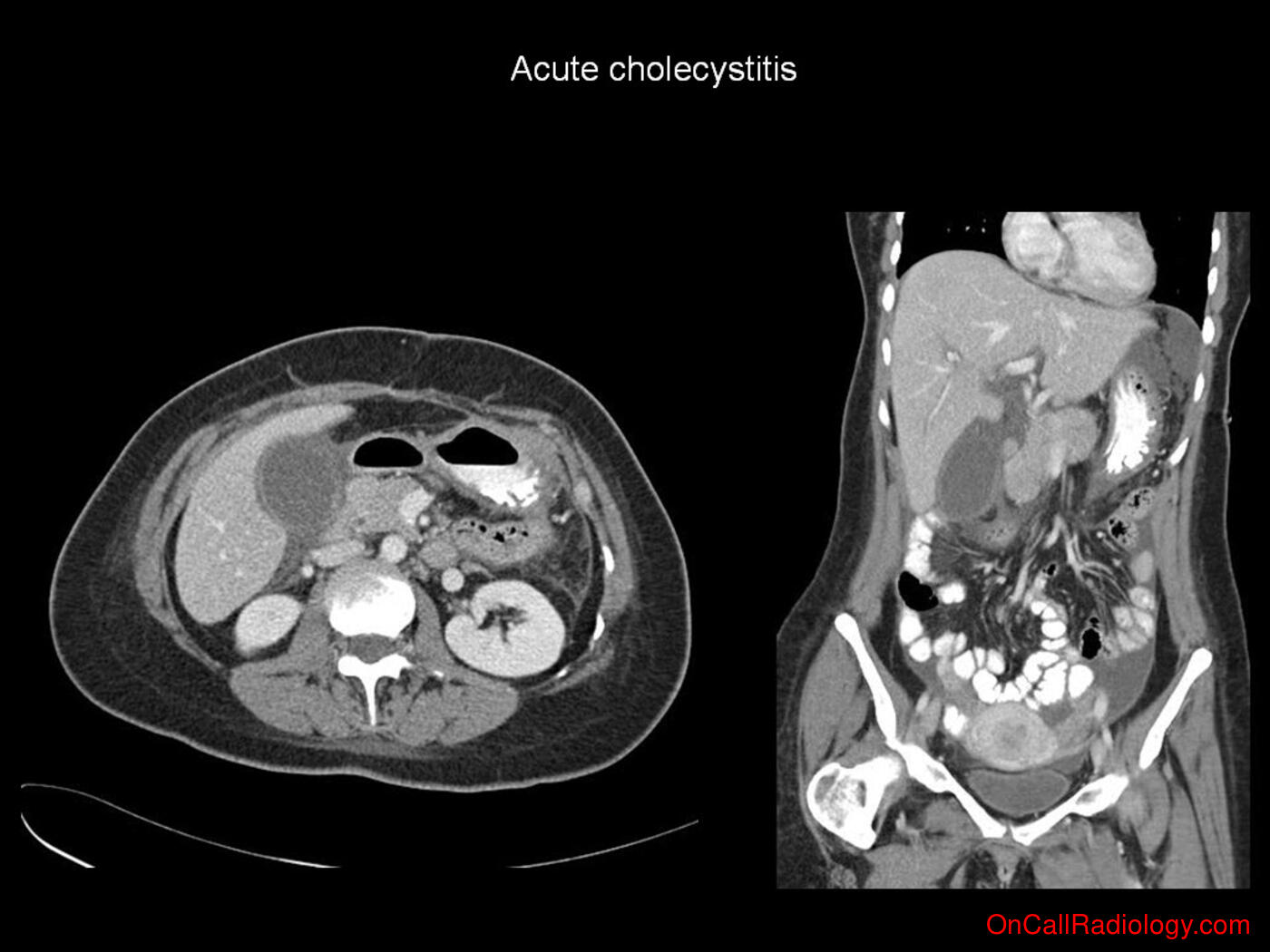 Mass effect (Acute cholecystitis - Plain film, Radiograph, CT, Computed tomography)