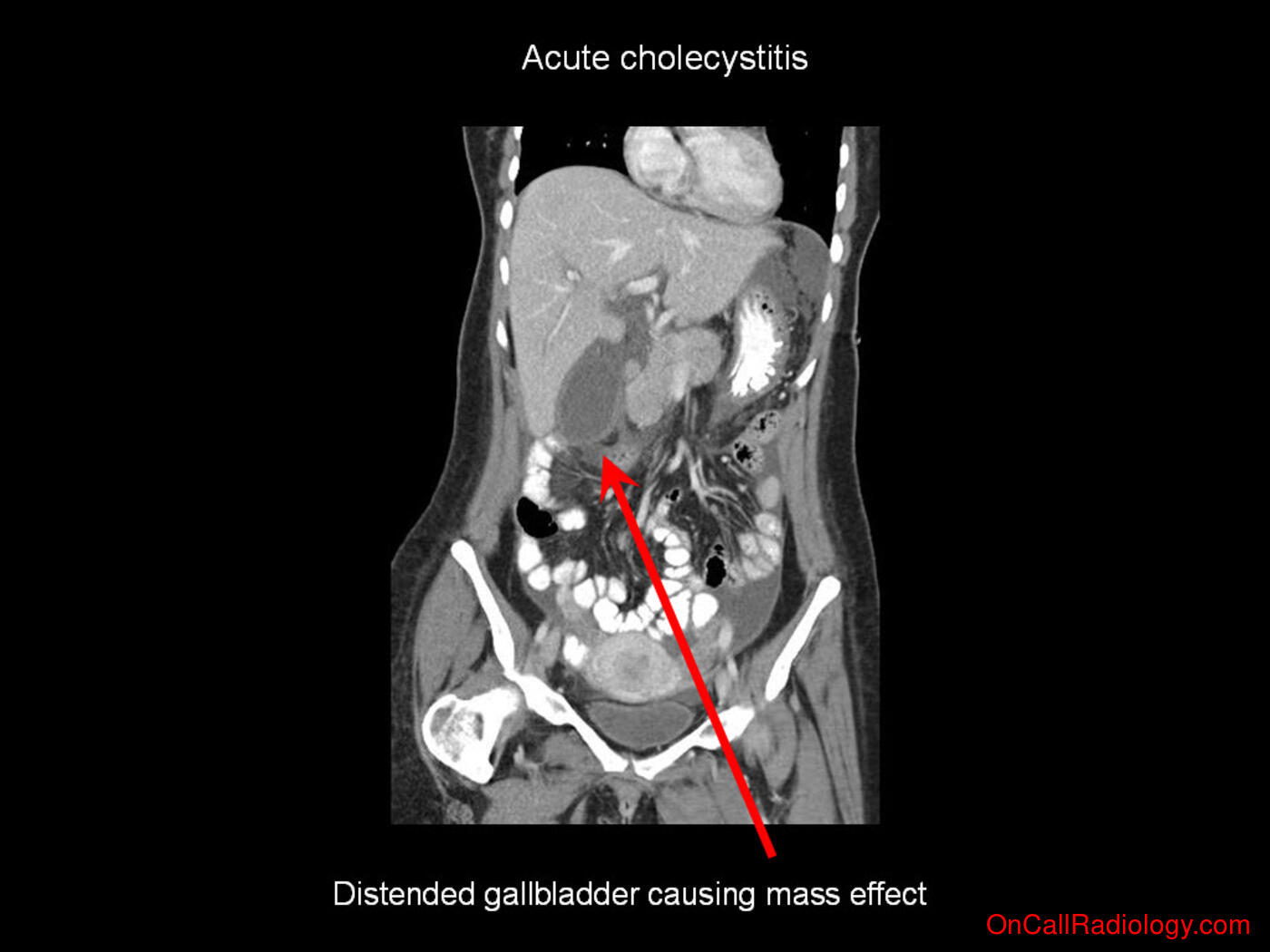 Mass effect (Acute cholecystitis - Plain film, Radiograph, CT, Computed tomography)