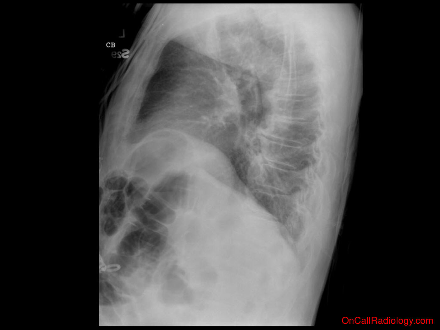 Air where it not belongs (Pneumoperitoneum mimicker - Plain film, Radiograph, CT, Computed tomography)