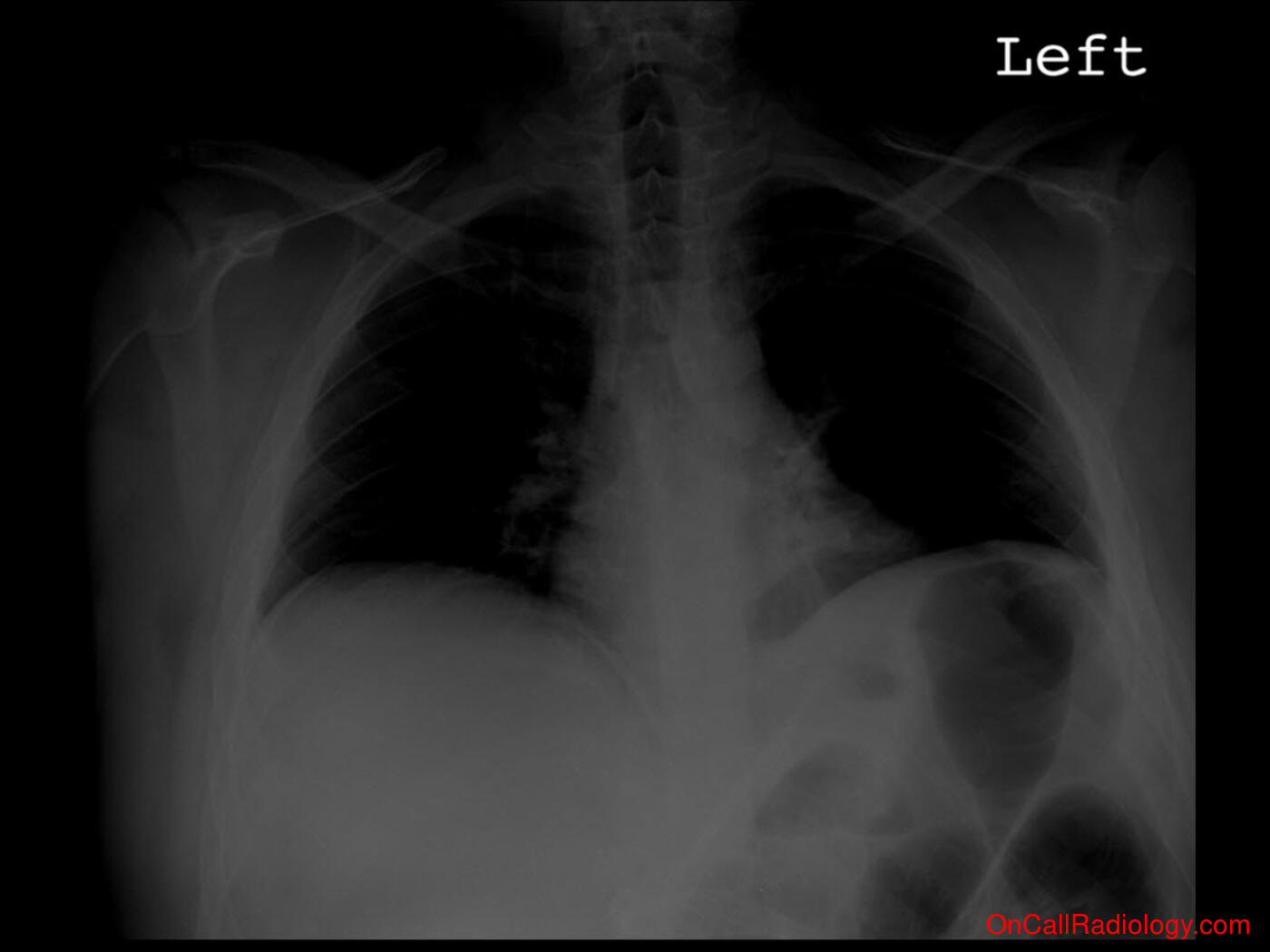 Air where it not belongs (Pneumoperitoneum - Plain film, Radiograph, CT, Computed tomography)