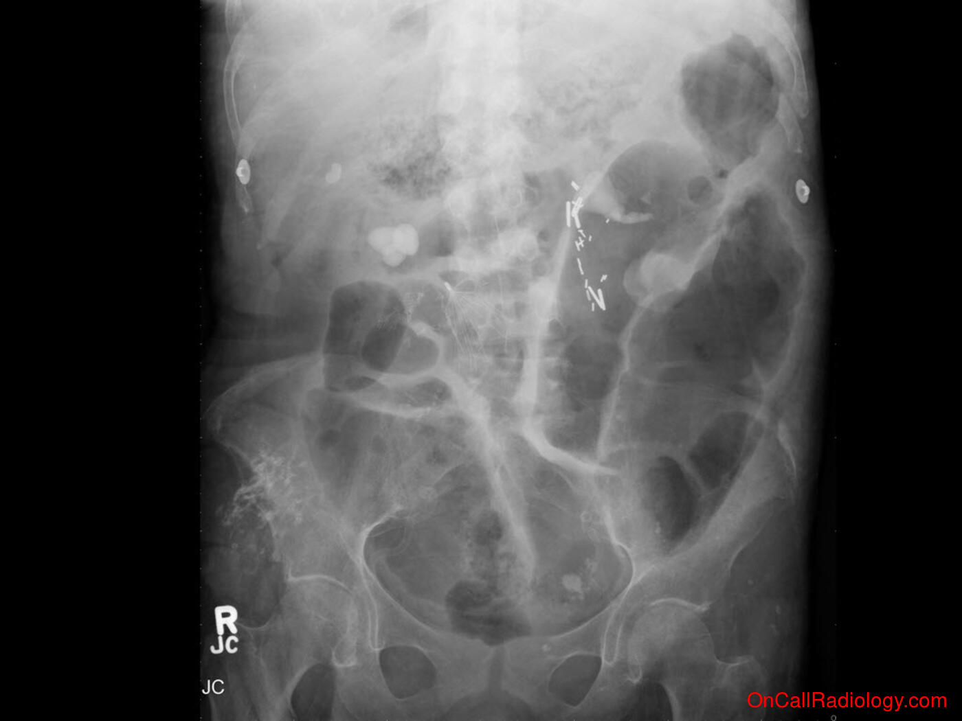 Obstruction (Pneumatosis - Plain film, Radiograph, CT, Computed tomography)