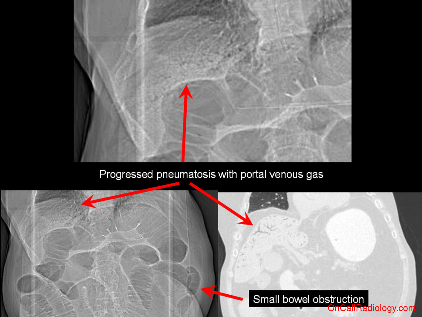 Obstruction (Pneumatosis and portal venous gas - Plain film, Radiograph, CT, Computed tomography)
