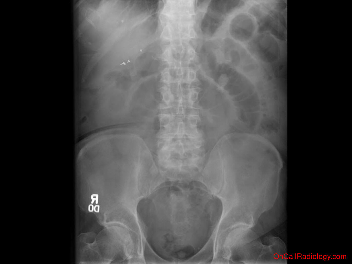 Obstruction (Small bowel obstruction - Plain film, Radiograph)