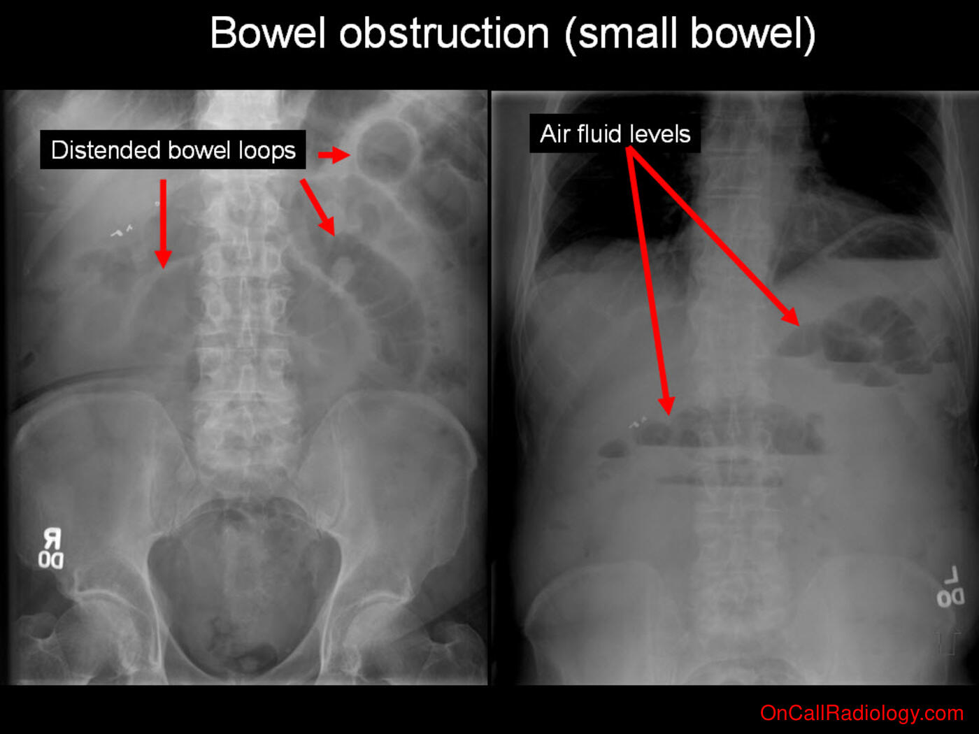 Obstruction (Small bowel obstruction - Plain film, Radiograph)