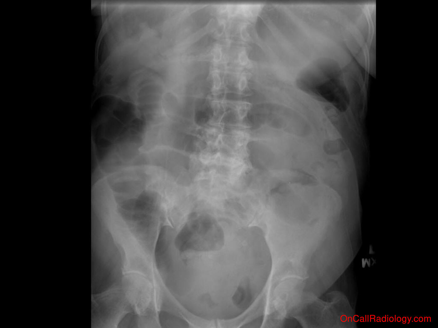 Obstruction (Large bowel obstruction - Plain film, Radiograph, CT, Computed tomography)