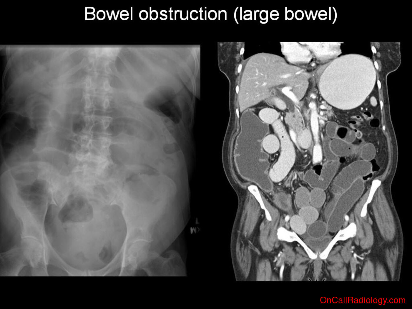 Obstruction (Large bowel obstruction - Plain film, Radiograph, CT, Computed tomography)