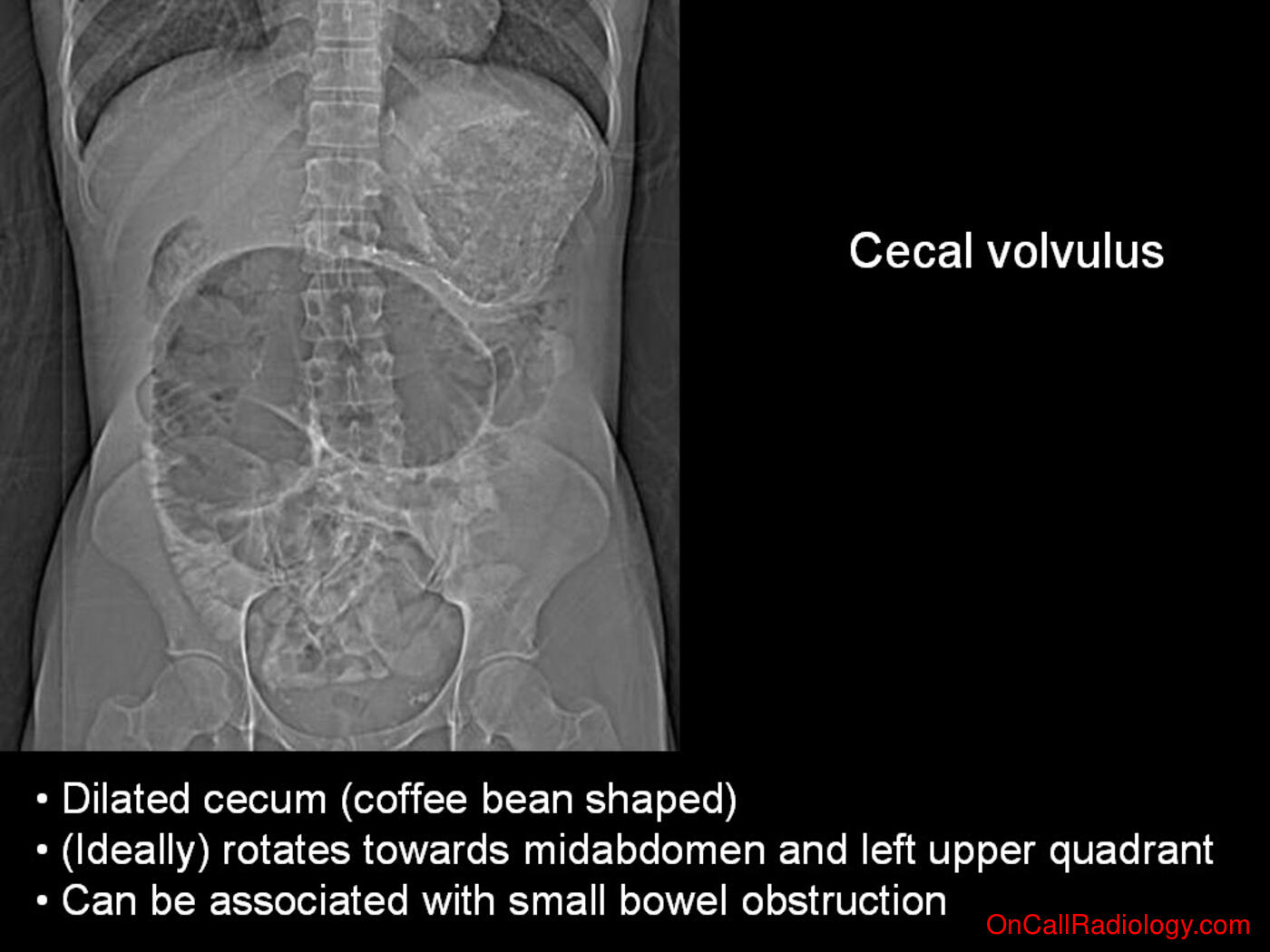 Obstruction (Cecal volvulus - Plain film, Radiograph)