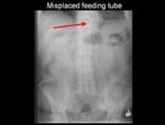 Misplaced feeding tube