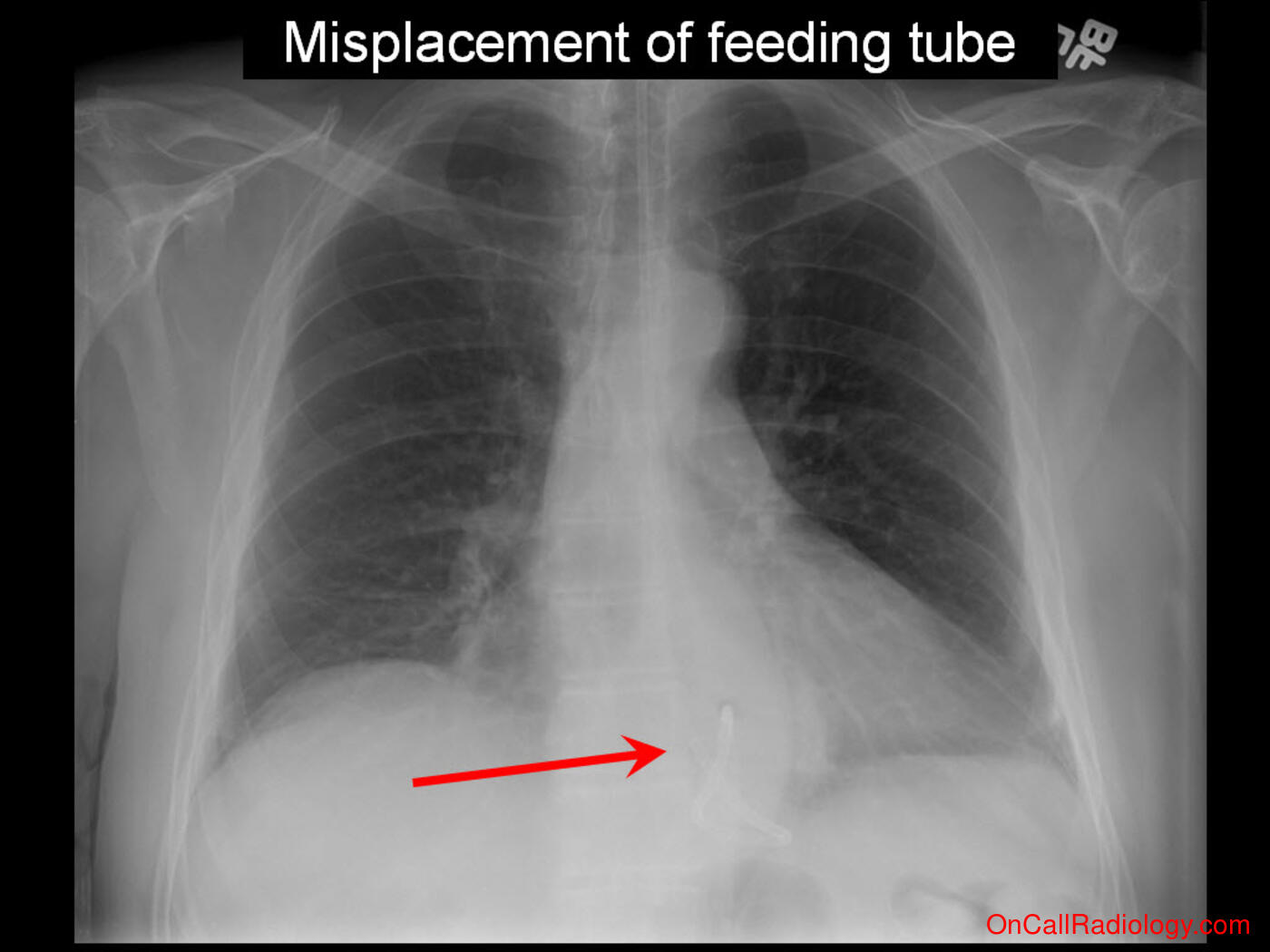 Devices (Misplaced feeding tube - Plain film, Radiograph)