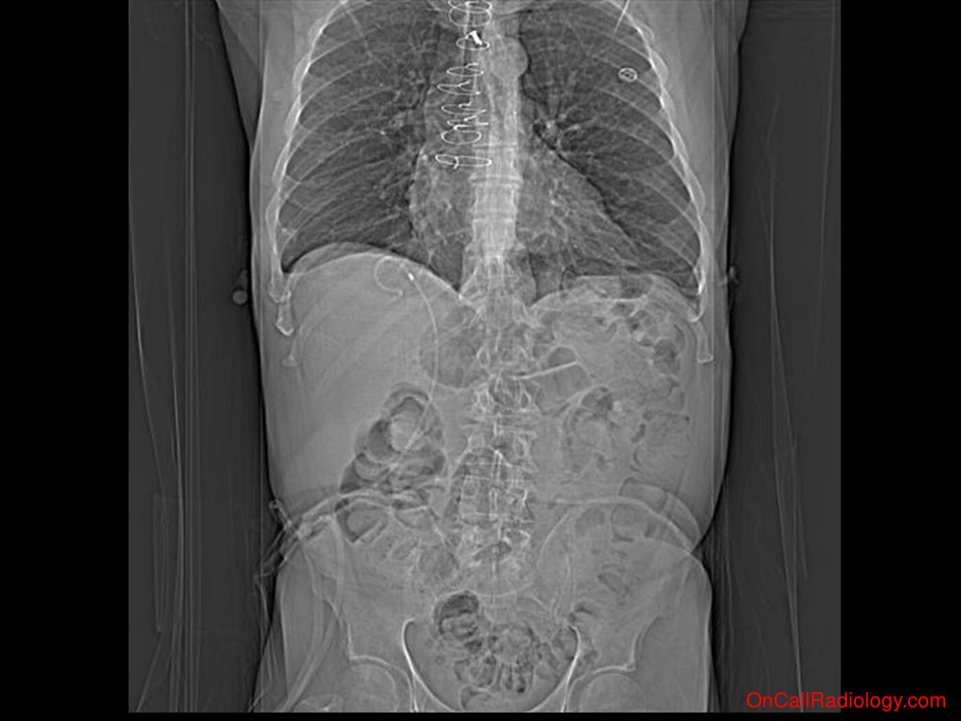 Devices (Misplaced feeding tube - Plain film, Radiograph, CT, Computed tomography)