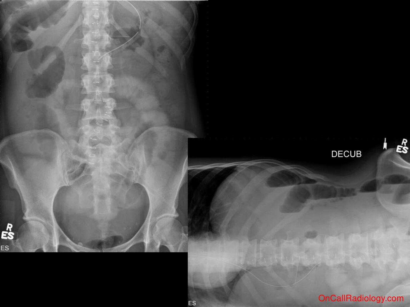 Obstruction (Small bowel obstruction - Plain film, Radiograph, CT, Computed tomography)