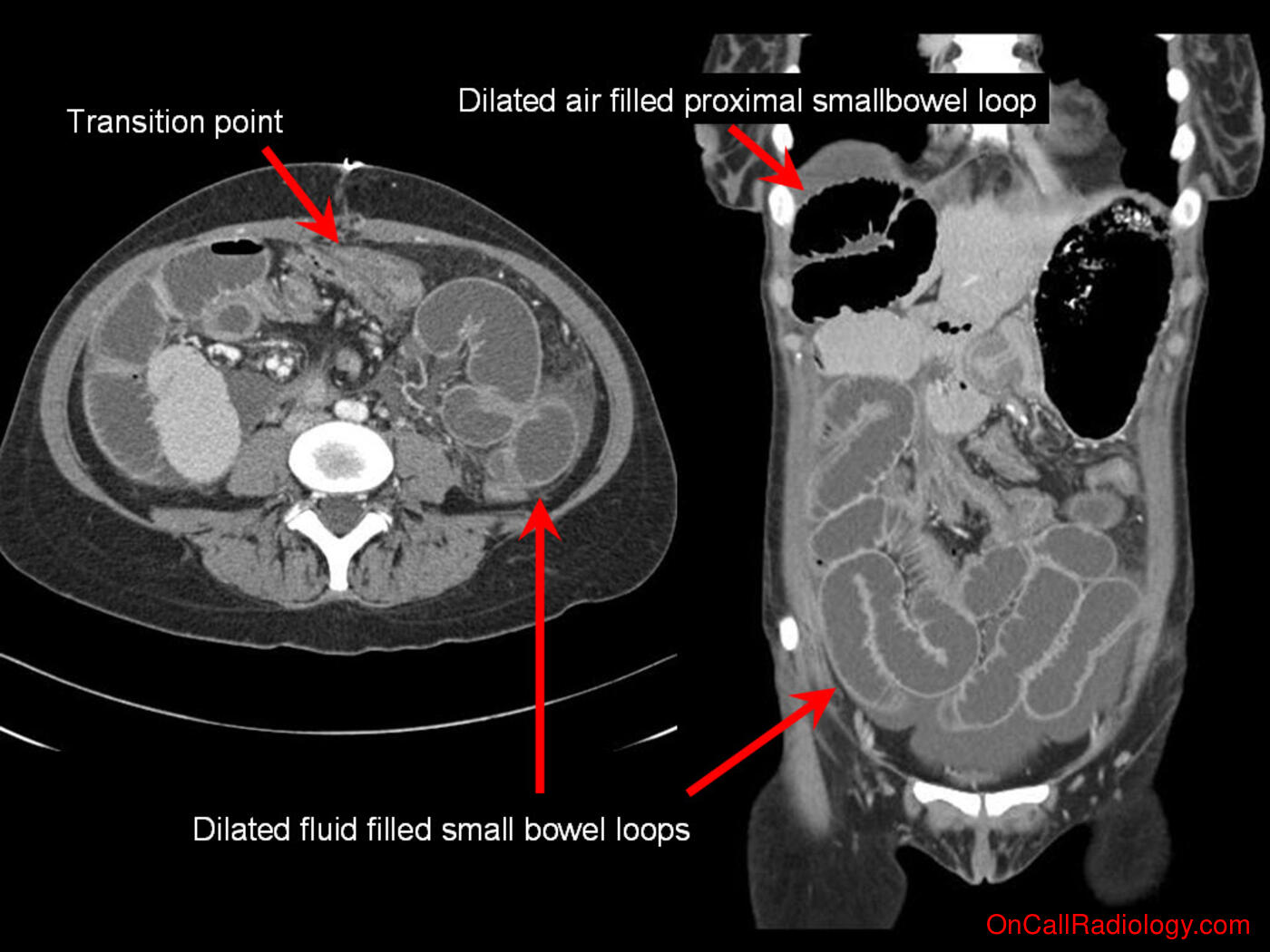Obstruction (Small bowel obstruction - Plain film, Radiograph, CT, Computed tomography)